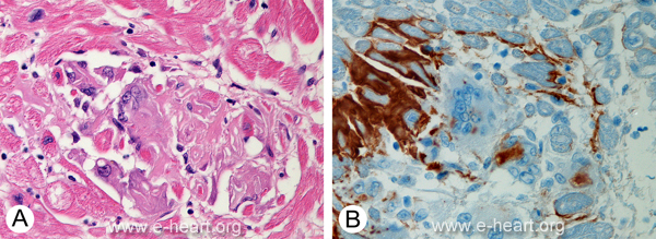 Amyloid and foreign body giant cell reaction